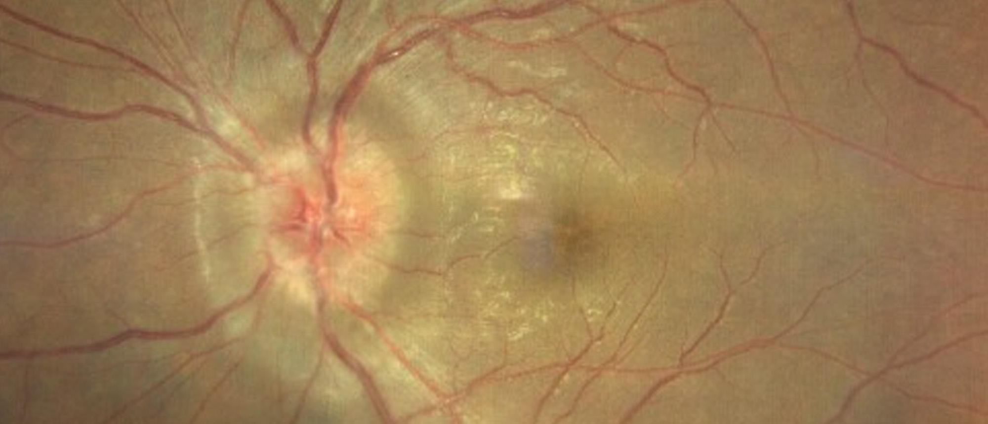 Neurosyphilis 