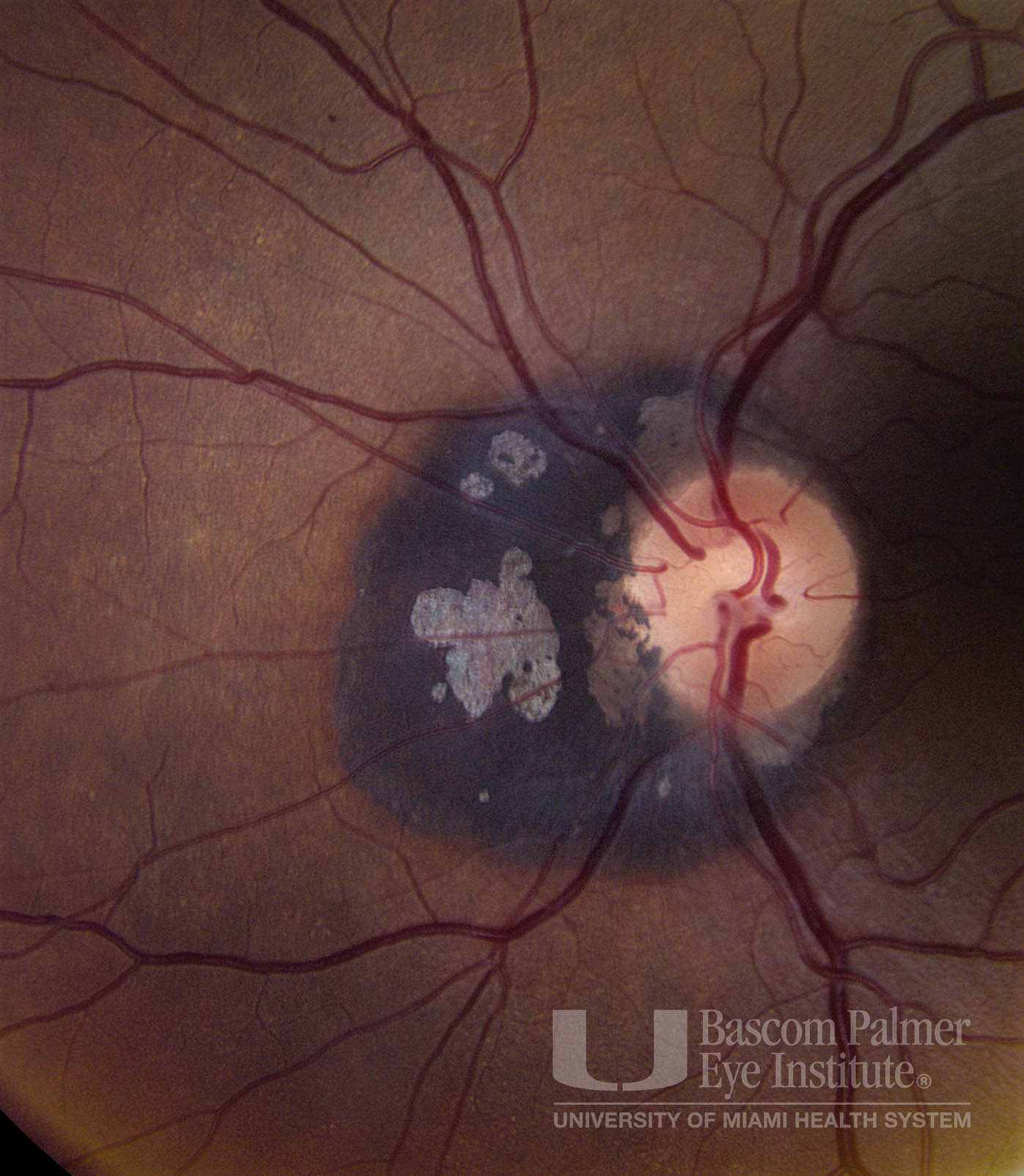 Course: Peripapillary Congenital Hypertrophy of the Retinal Pigment ...