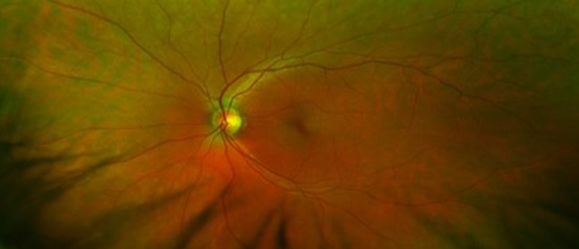 Congenital Hypertrophy of Retinal Pigmented Epithelium (CHRPE), with Secondary Retinal Pigmented Epithelium Adenoma