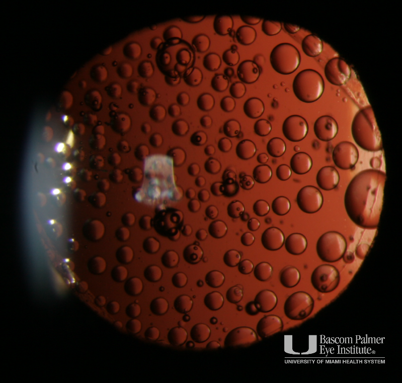 Silicone Oil Droplets on a Silicone Intraocular Lens
