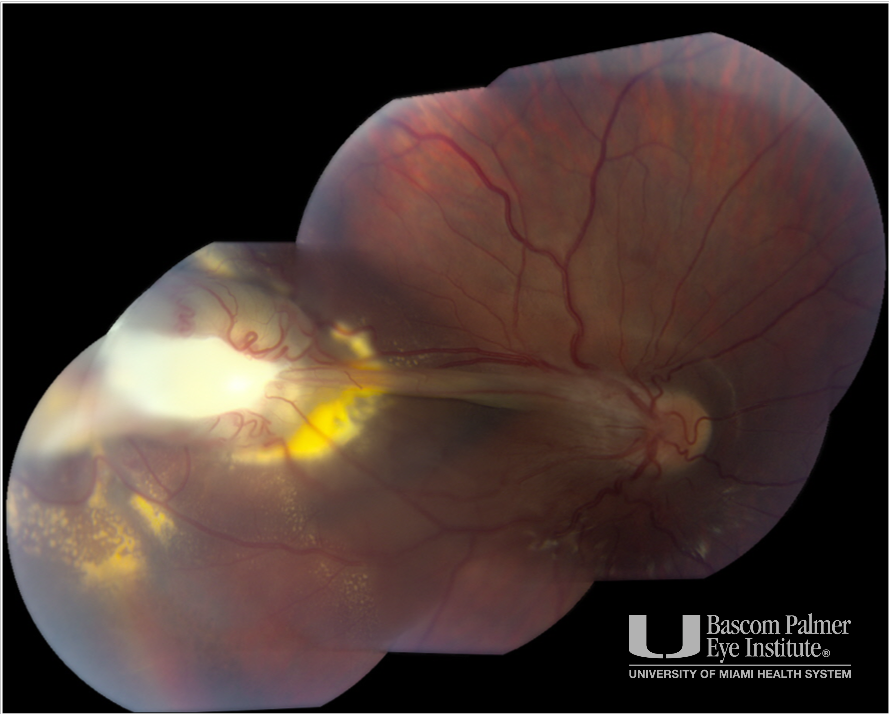 Toxocara With Tractional Retinal Detachment
