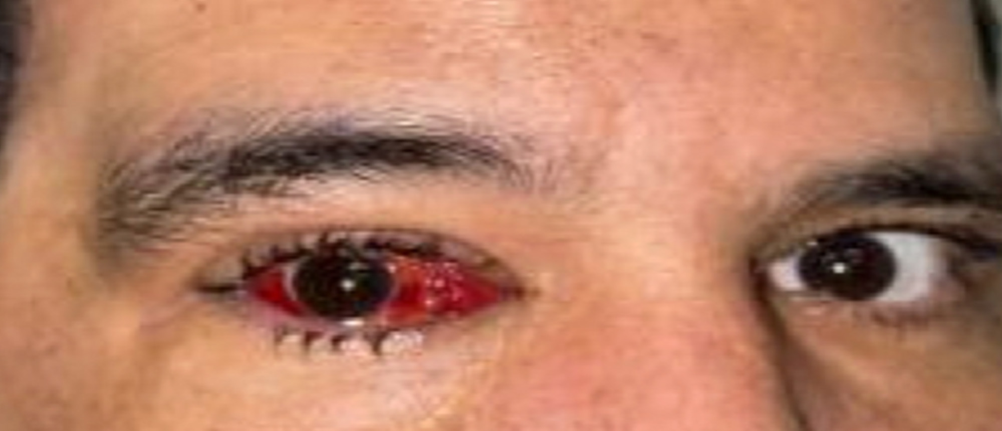 Pre and Post Operative Visits, Large Angle Exotropia