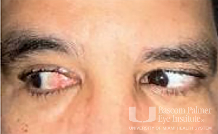 Pre and Post Operative Visits, Large Angle Exotropia