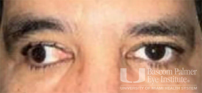 Pre and Post Operative Visits, Large Angle Exotropia