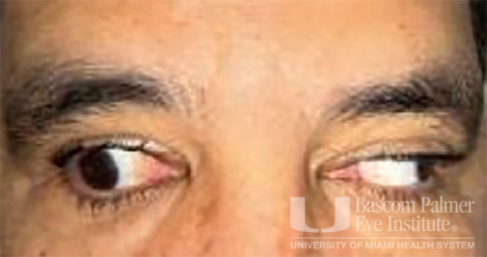 Pre and Post Operative Visits, Large Angle Exotropia