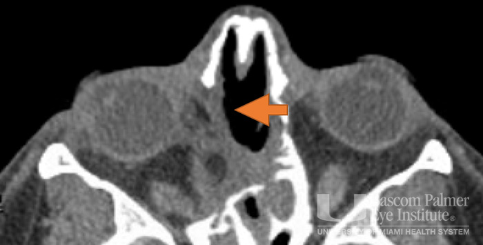 Pre and Post Operative Visits, Large Angle Exotropia