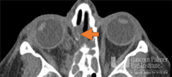 Pre and Post Operative Visits, Large Angle Exotropia