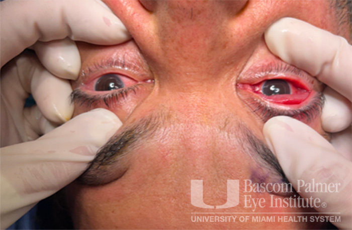 Pre and Post Operative Visits, Large Angle Exotropia