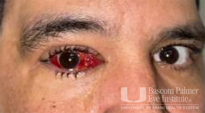 Pre and Post Operative Visits, Large Angle Exotropia