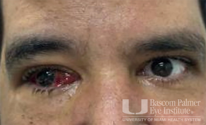 Pre and Post Operative Visits, Large Angle Exotropia