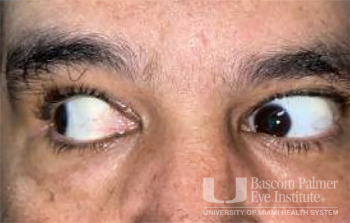 Pre and Post Operative Visits, Large Angle Exotropia