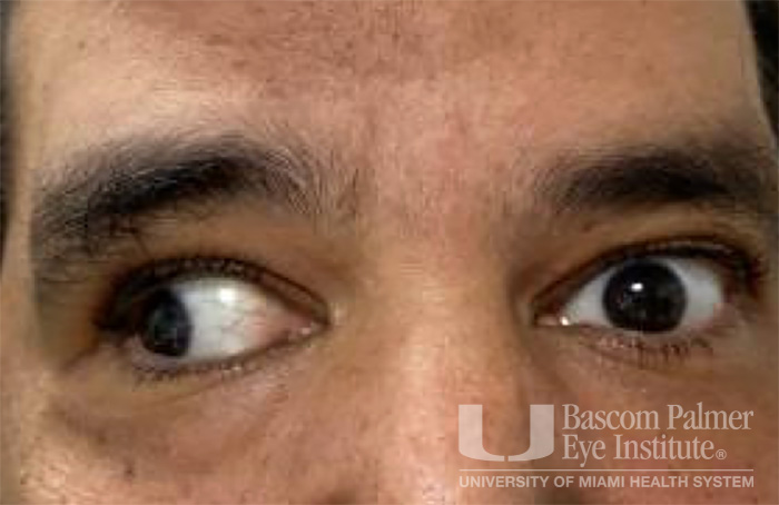 Pre and Post Operative Visits, Large Angle Exotropia