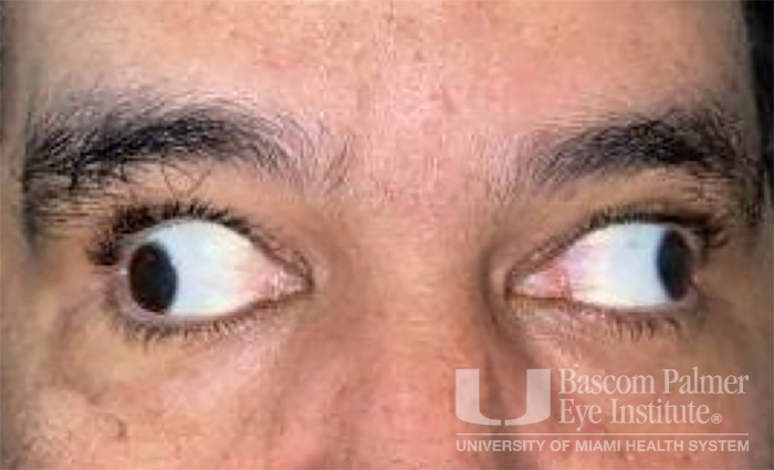 Pre and Post Operative Visits, Large Angle Exotropia