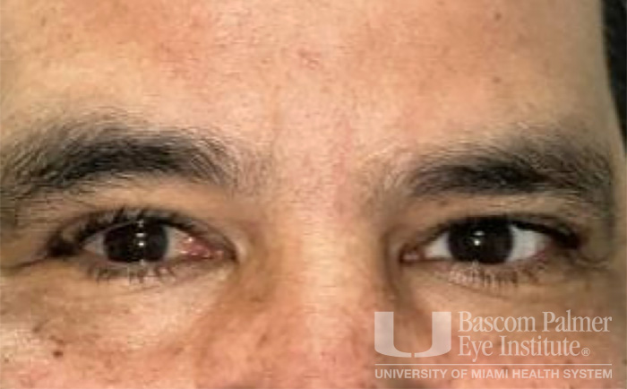 Pre and Post Operative Visits, Large Angle Exotropia