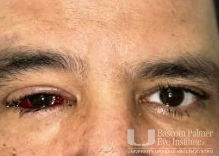 Pre and Post Operative Visits, Large Angle Exotropia