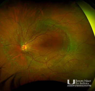 Wegner's Syndrome With Tractional Retinal Detachment