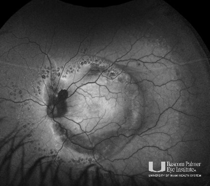 Wegner's Syndrome With Tractional Retinal Detachment