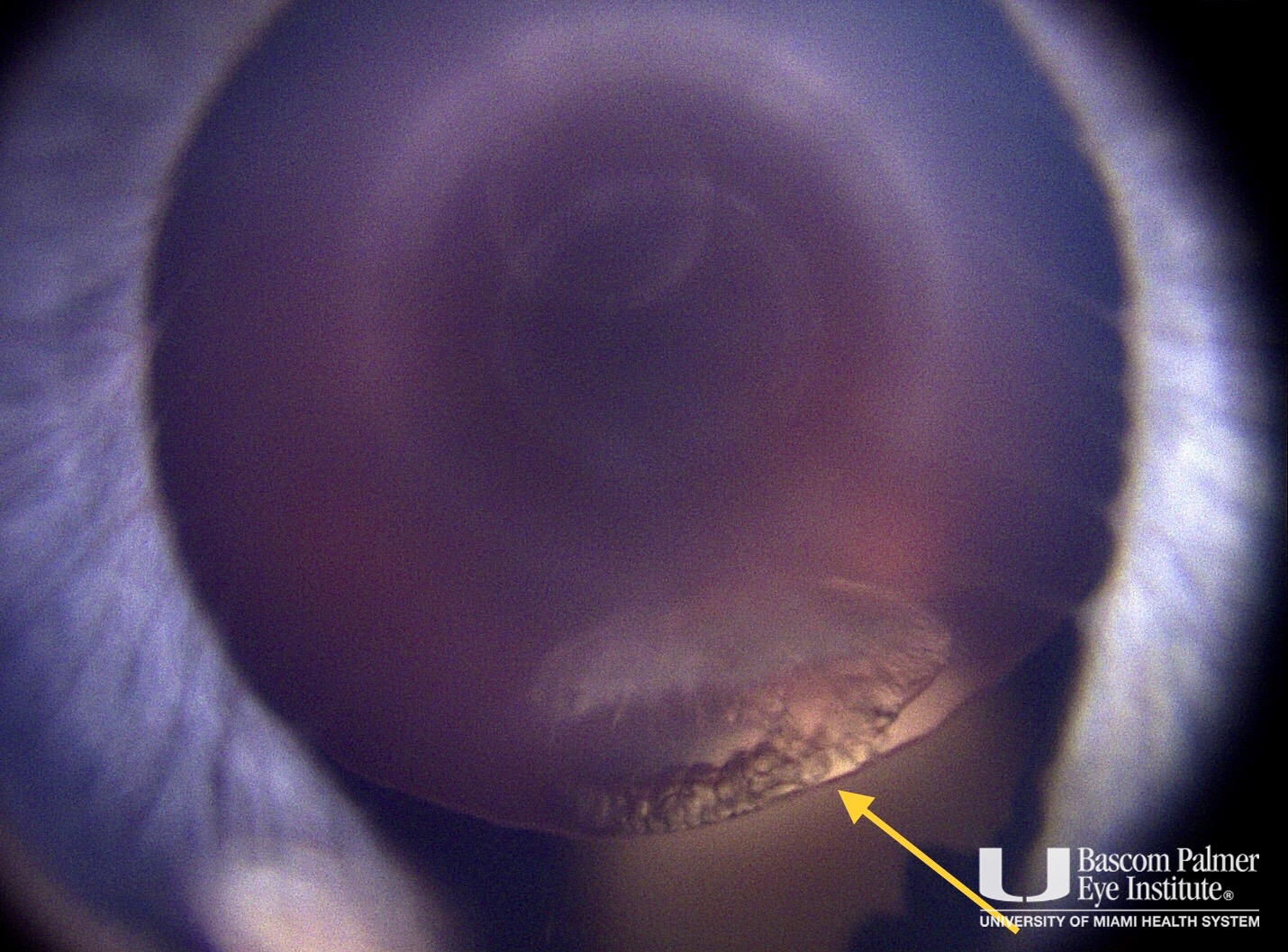 Iris, Lens and Zonule Coloboma