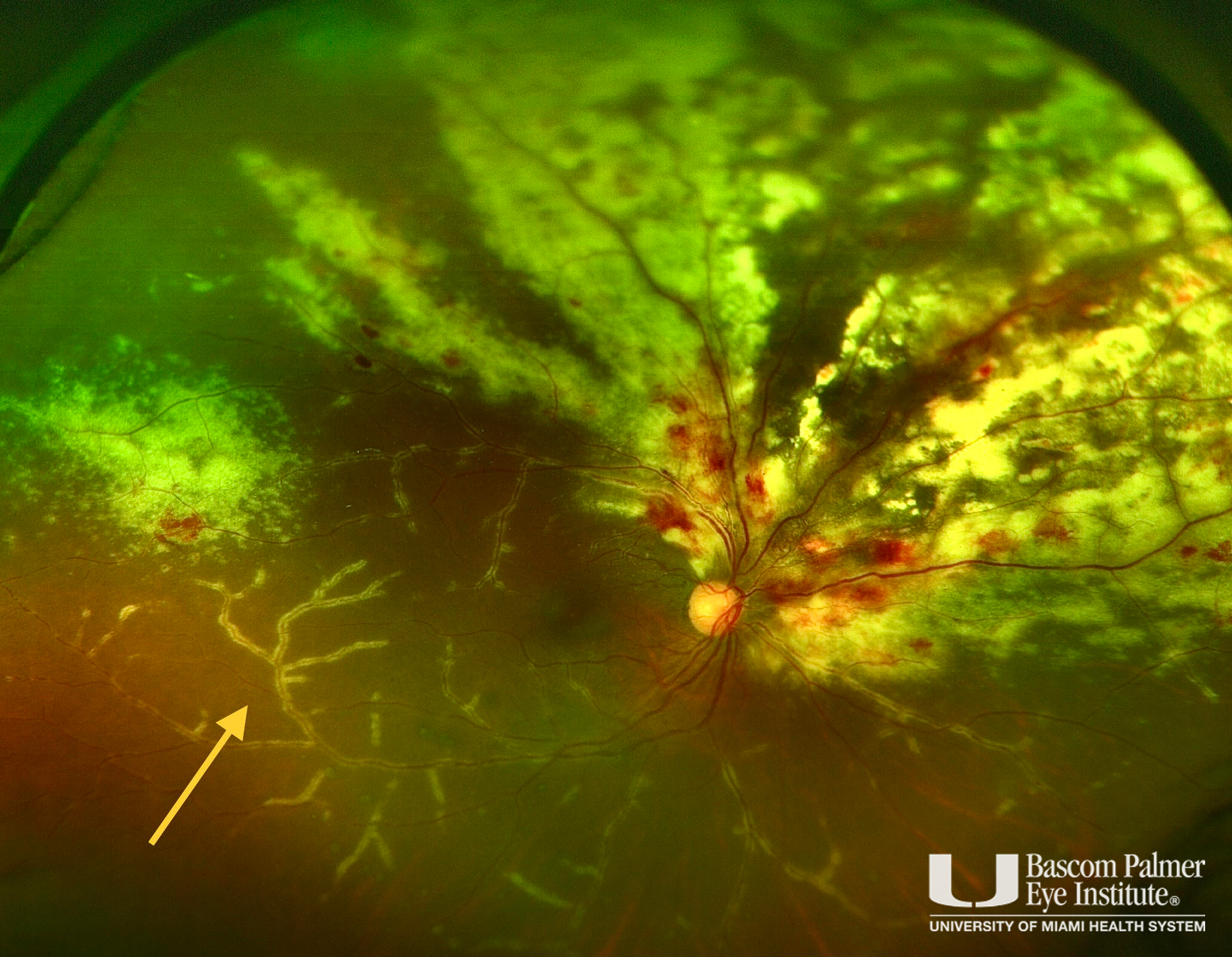 CMV Retinitis with Frosted Branch Angiitis