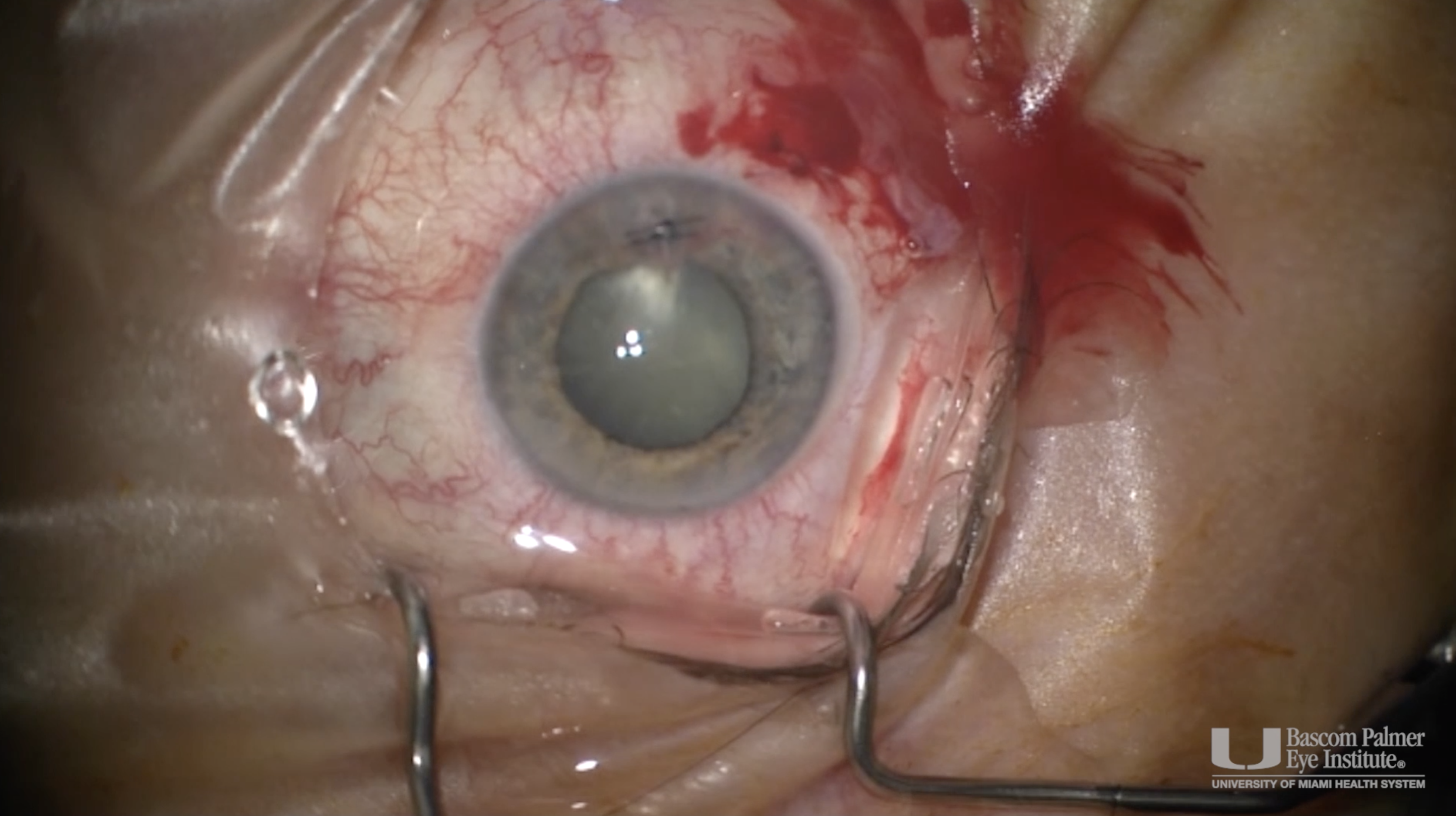 Removal of Staple, Repair of Open Globe, Lensectomy and Vitrectomy