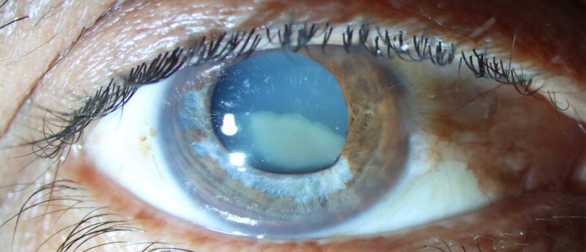 Morgagnian Cataract