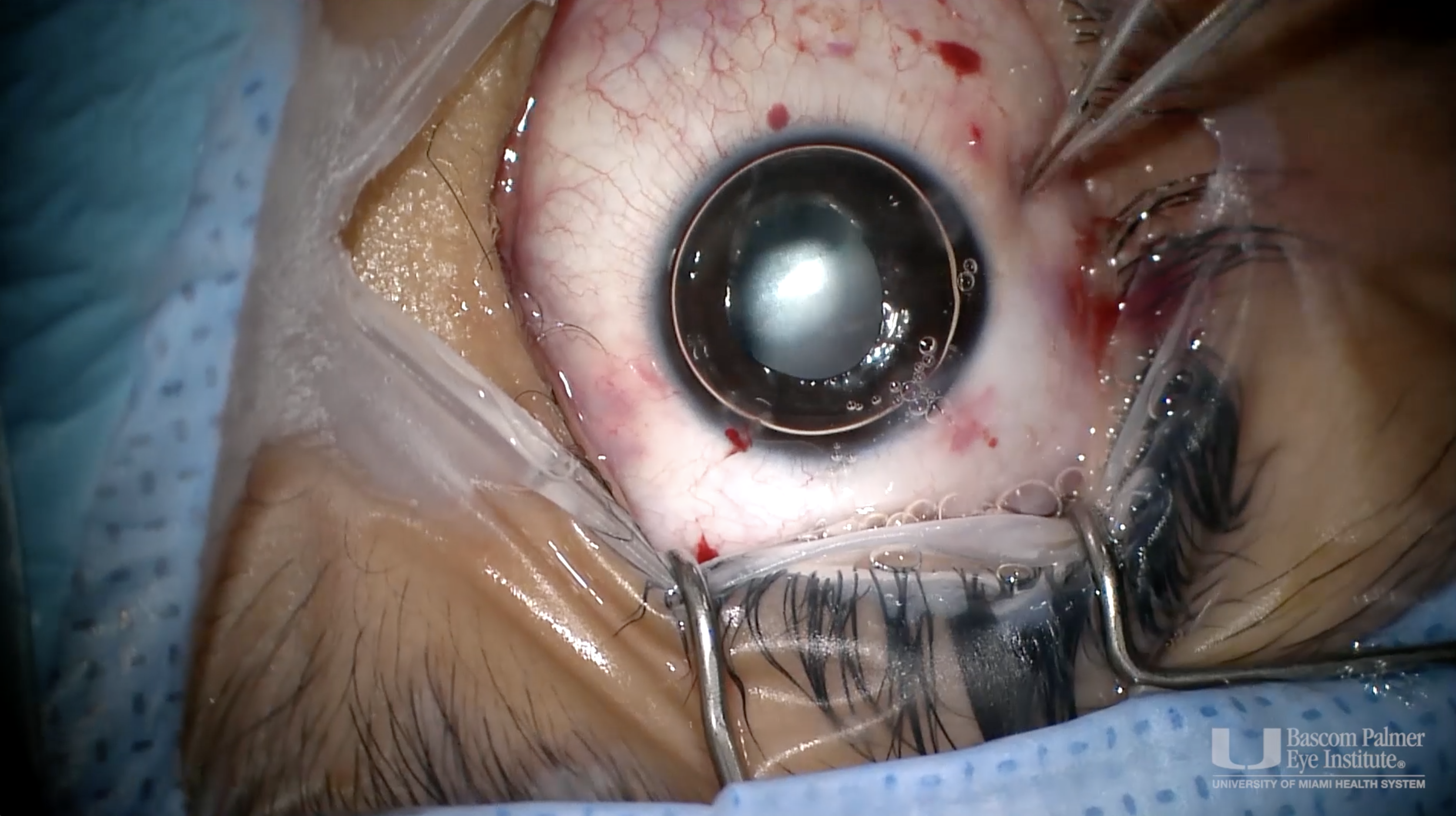 Pediatric Uveitic Cataract Removal with Lensectomy and Vitrectomy