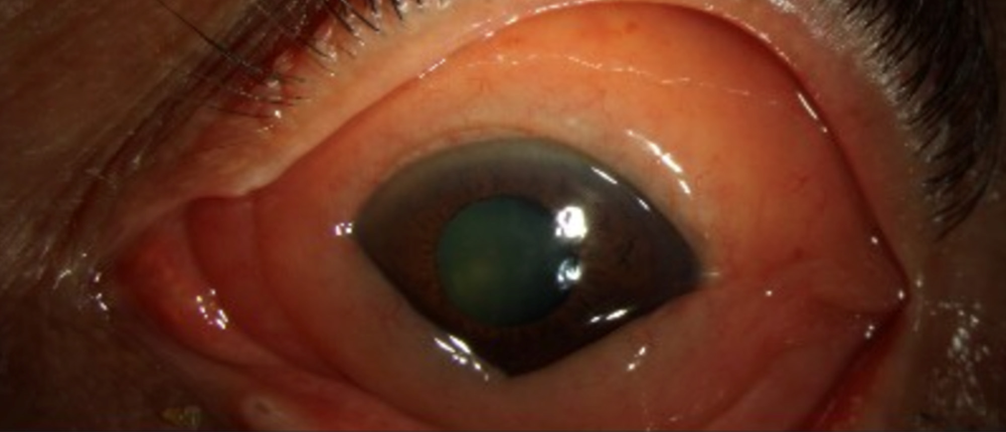 Conjunctival Lymphoma 