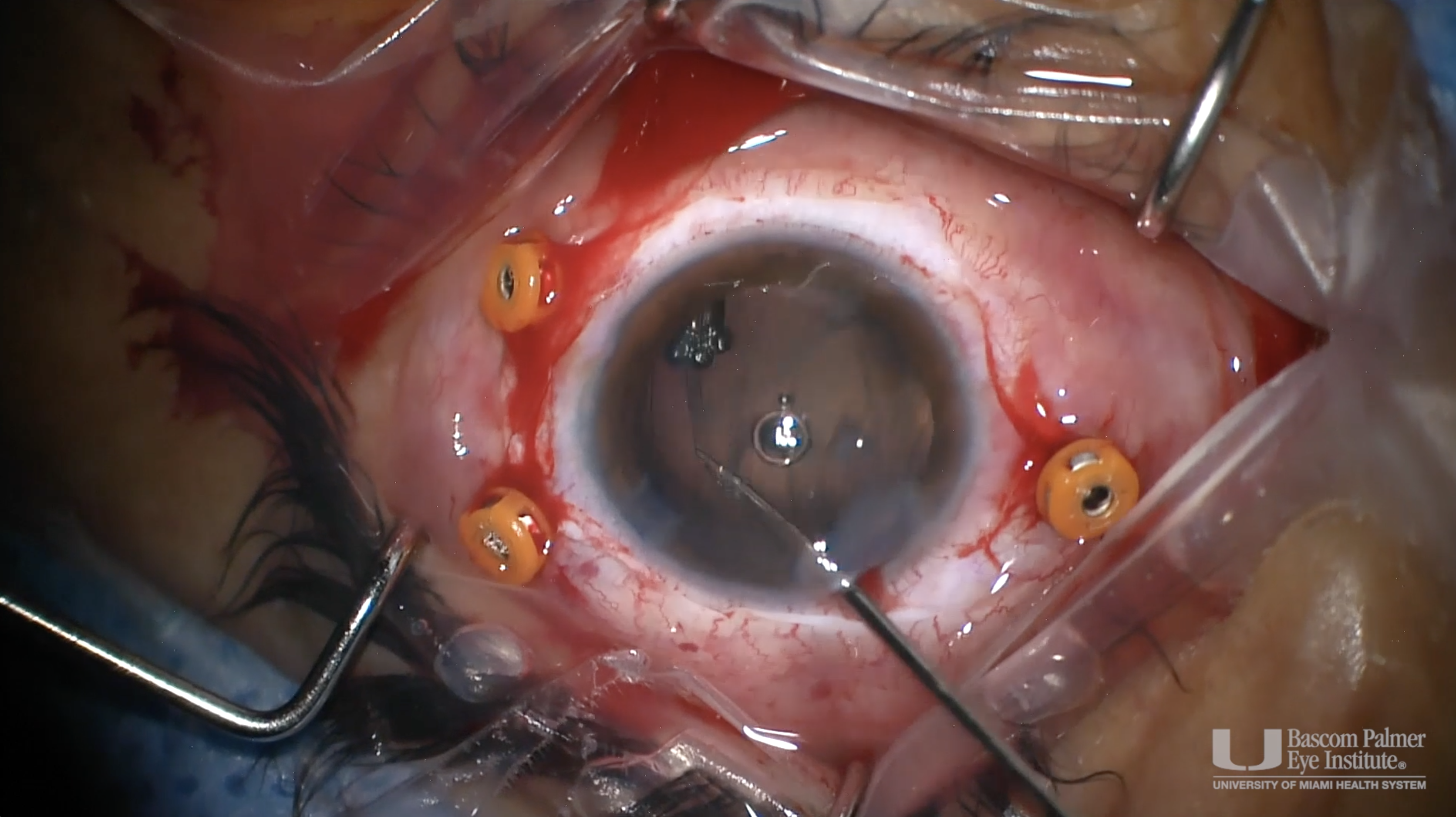 Removal of Intraocular Nail and Retinal Detachment Repair with Lensectomy and Vitrectomy
