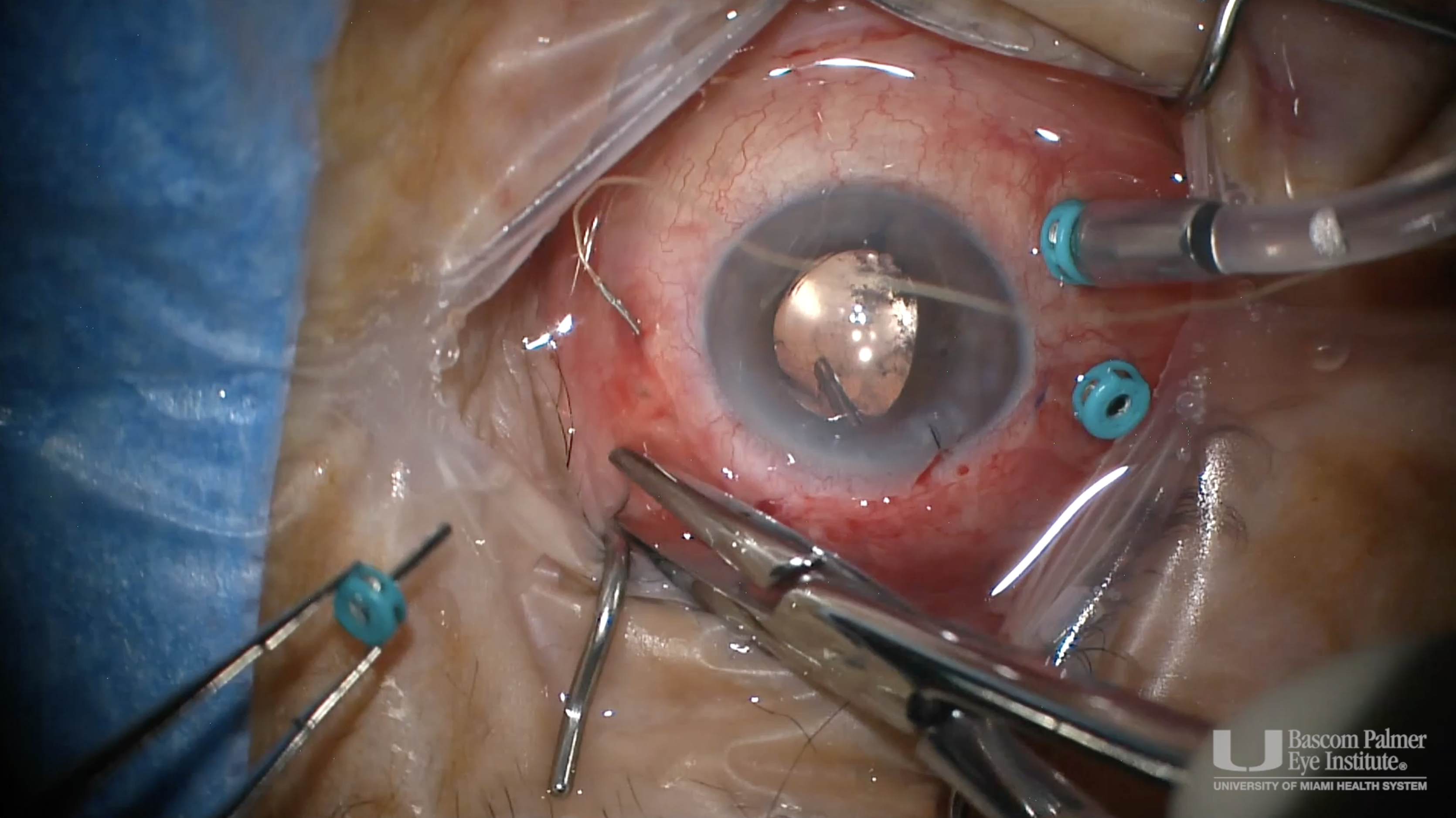Transzonular Vitrectomy for the Treatment of Aqueous Misdirection Glaucoma
