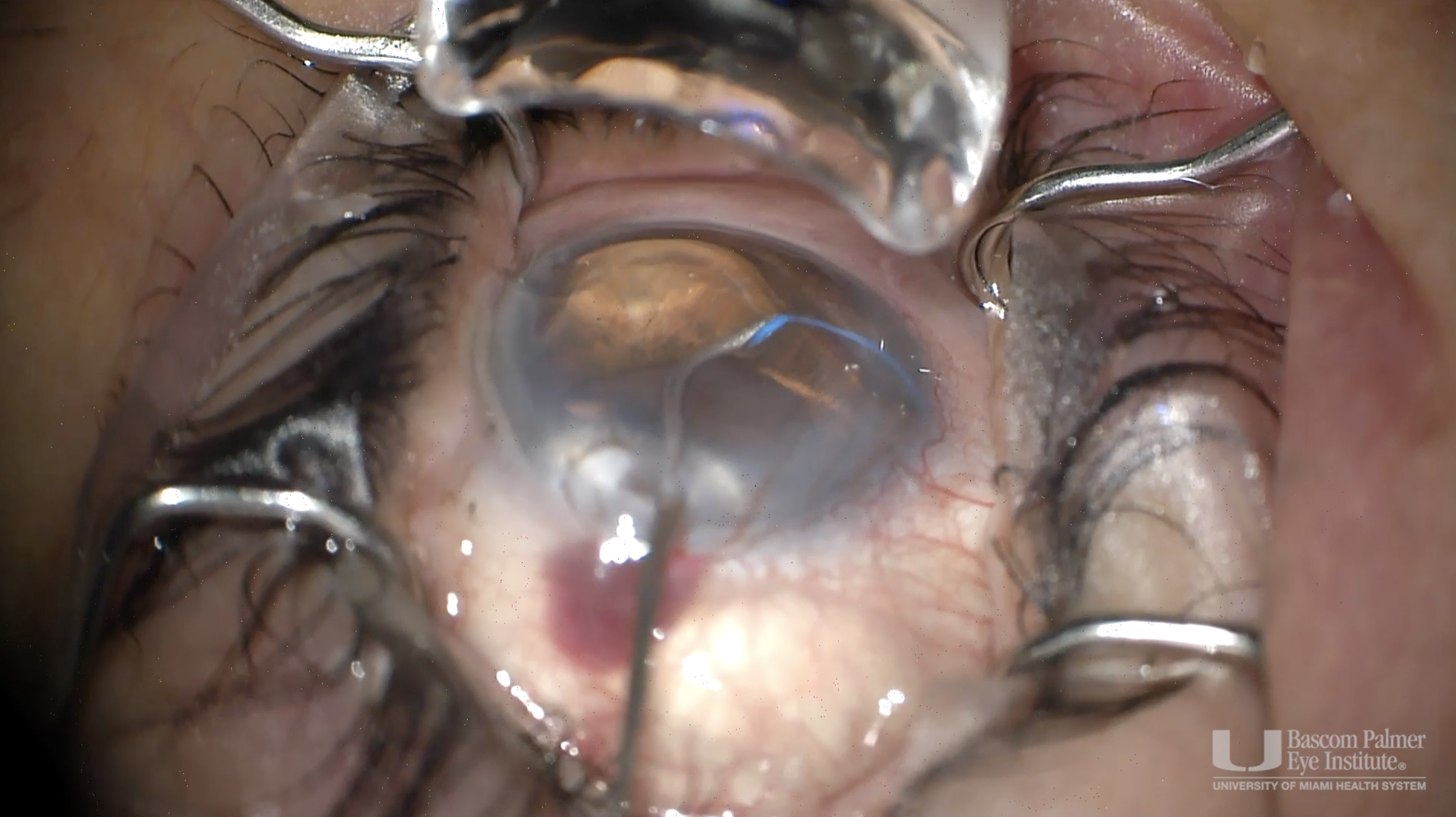 Omni Goniotomy for Glaucoma