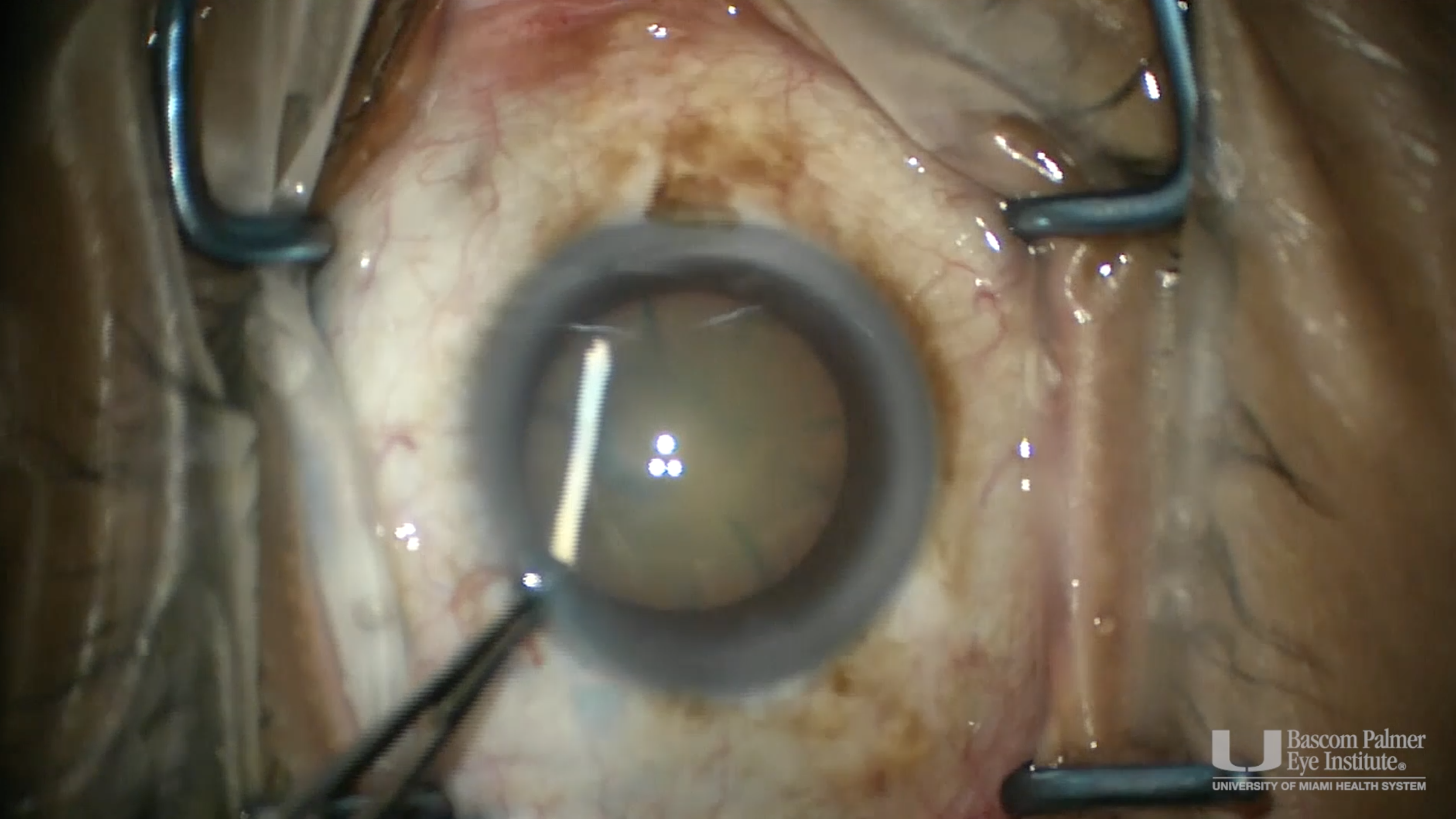 Removal of Cataract and Intralenticular Dexamethasone Implant