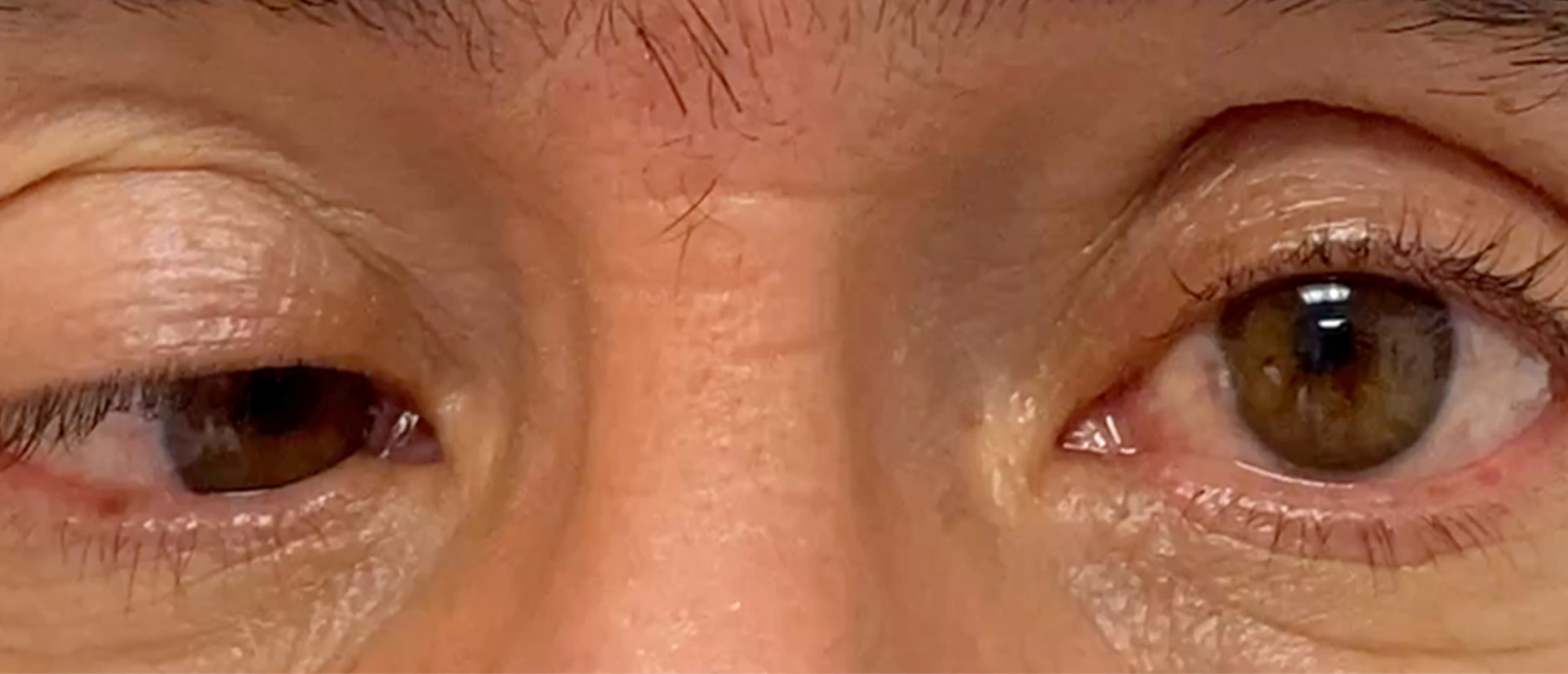 Combined 3rd and 6th Nerve Palsy Secondary to Cavernous Sinus Meningioma