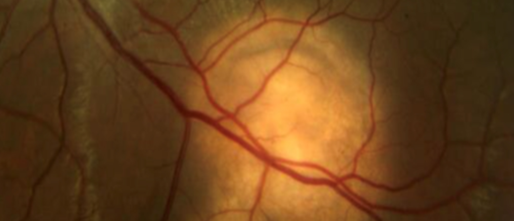 Ocular Tuberculosis