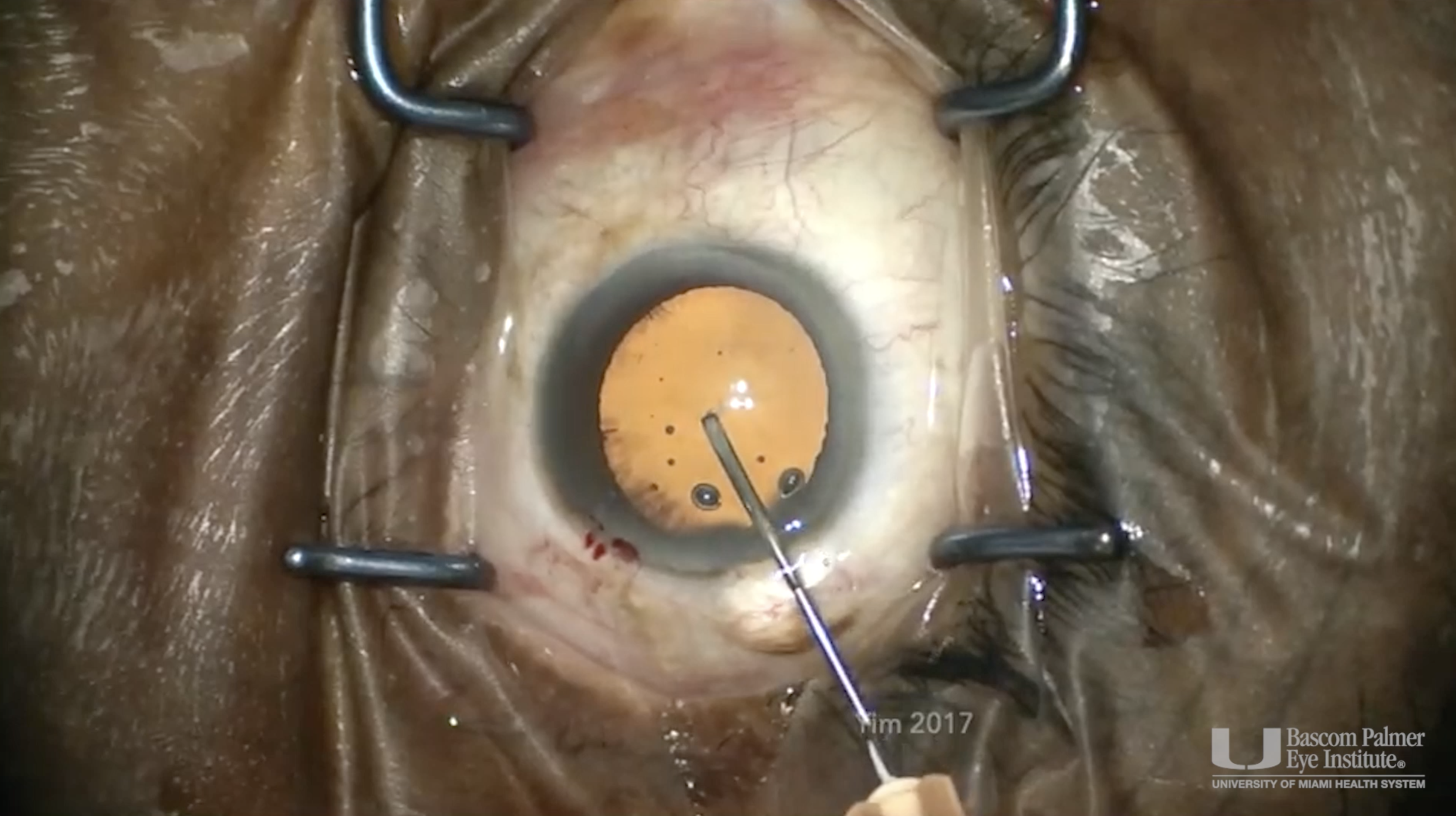 Stop- Stop and Chop Cataract Removal Technique