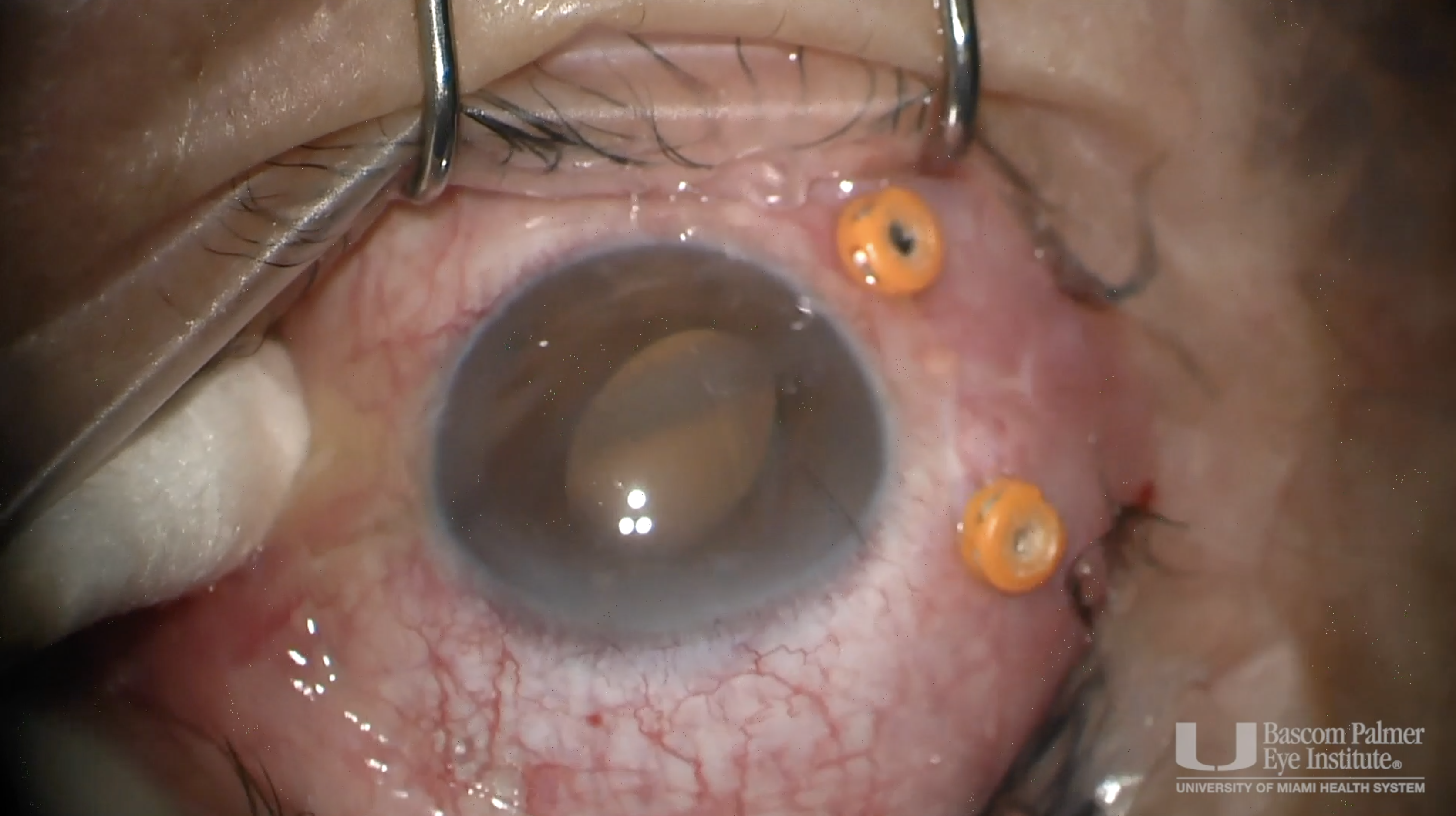 Silicone Oil Removal and EDTA Chelation for Band Keratopathy
