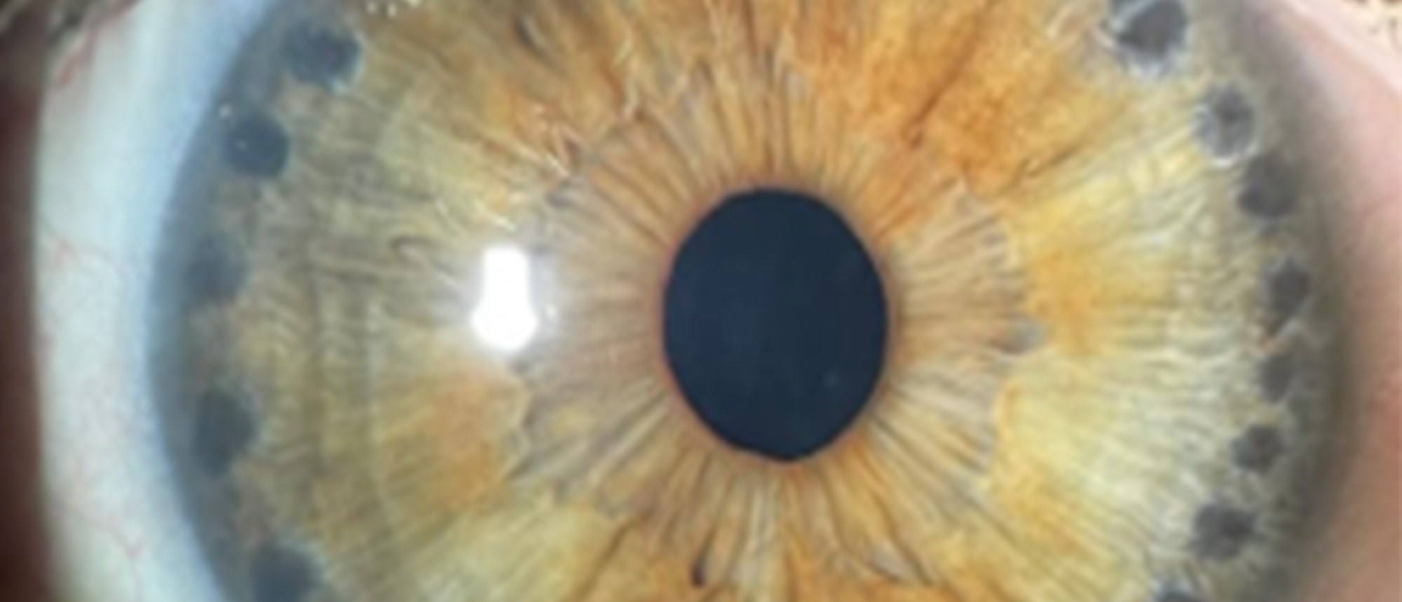 Plateau Iris Syndrome