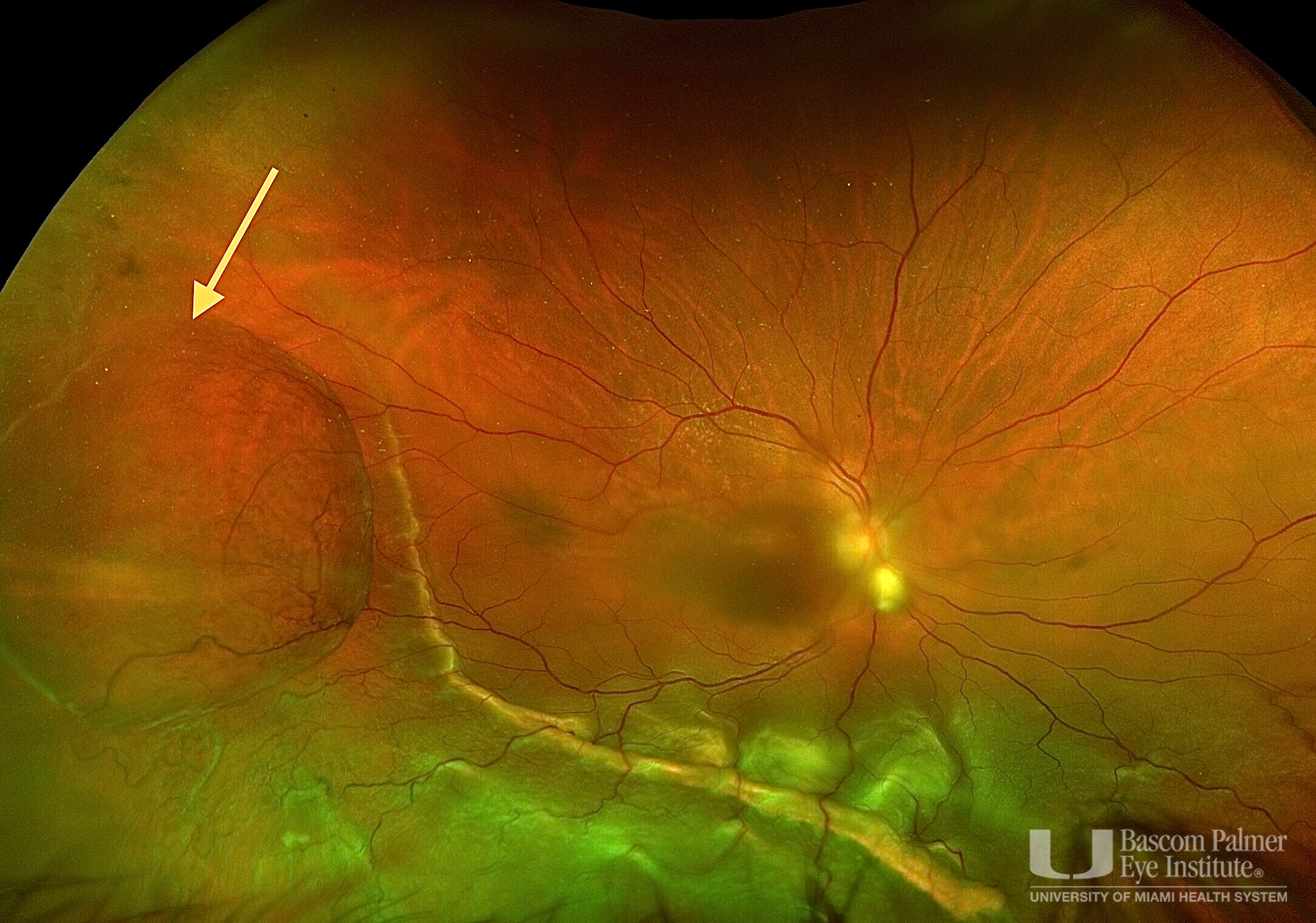 Chronic Retinal Detachment With Pseudocyst
