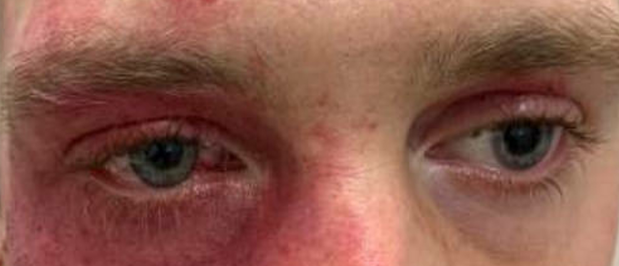 Diffuse Choroidal Hemangioma