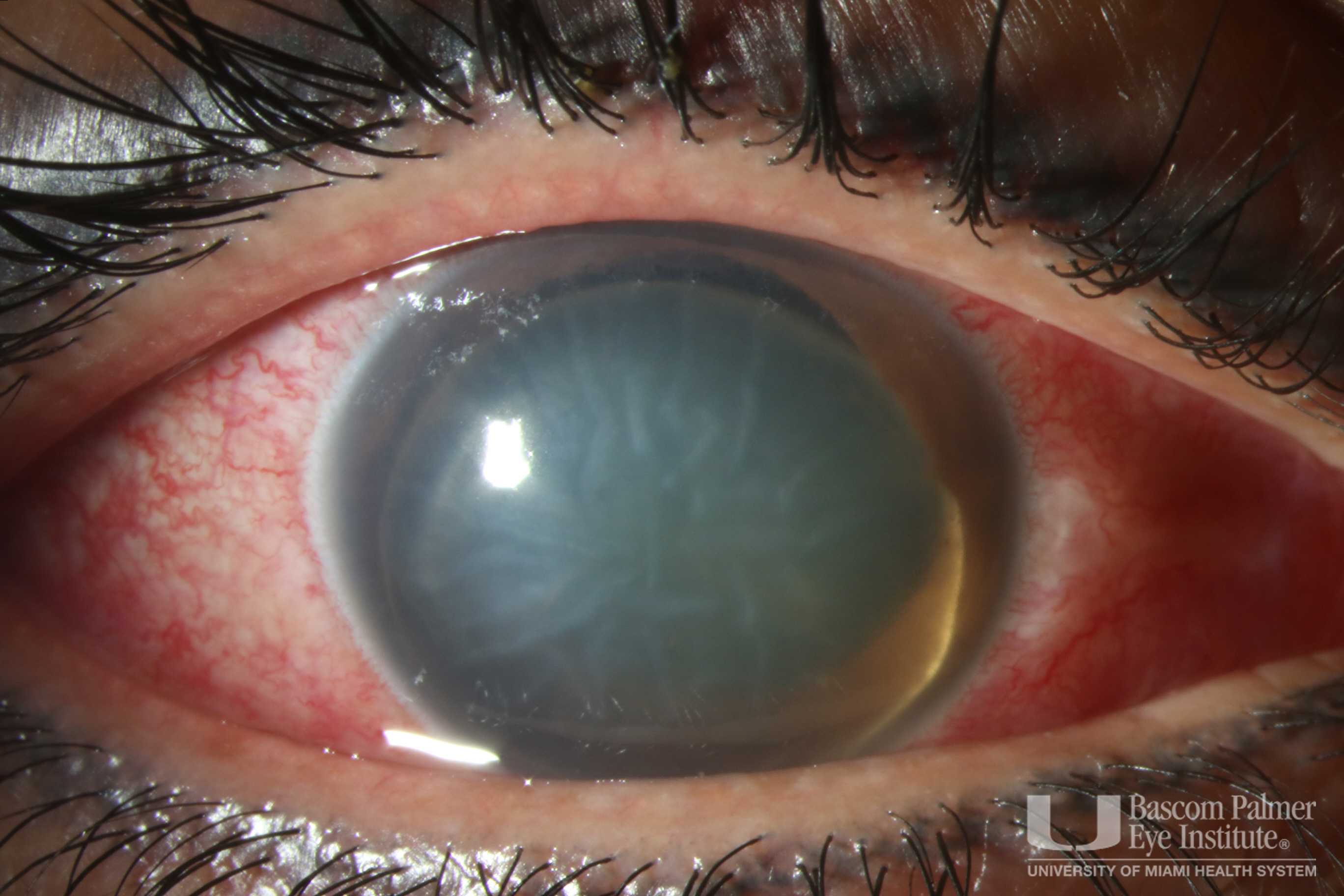 Anterior Dislocation of Crystalline Lens with Corneal Edema