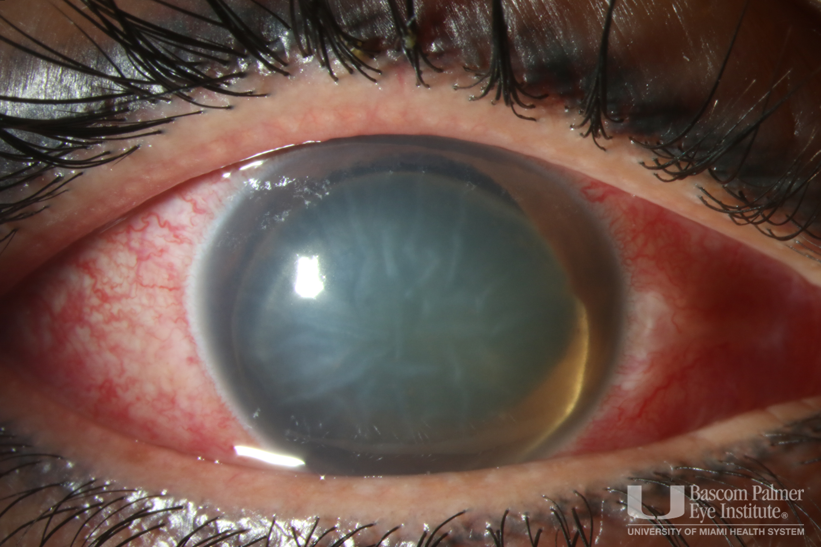 Anterior Dislocation of Cystalline Lens With Corneal Edema