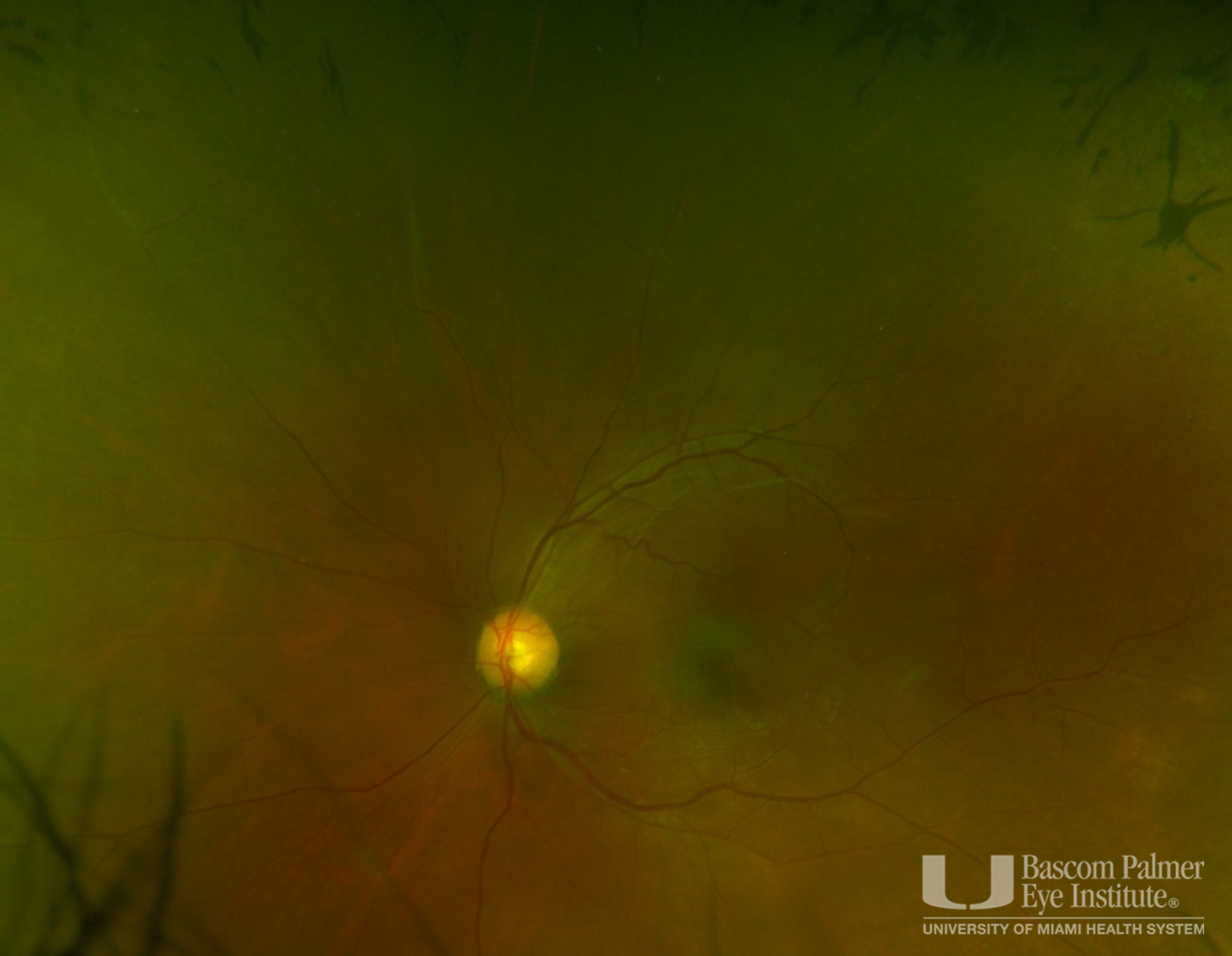 Retinitis Pigmentosa