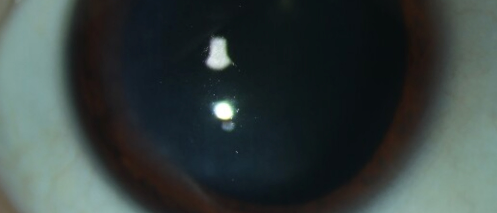 Smoldering Multiple Myeloma