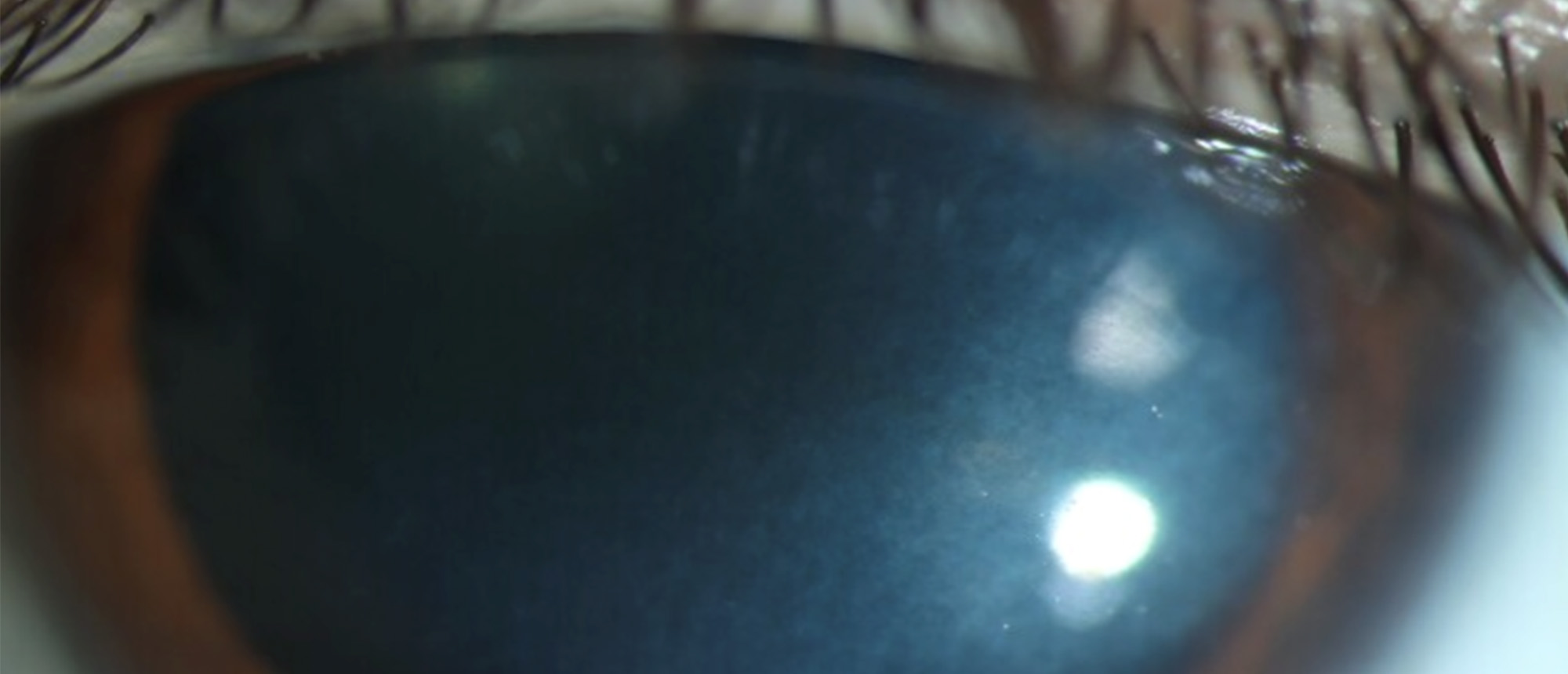 Smoldering Multiple Myeloma