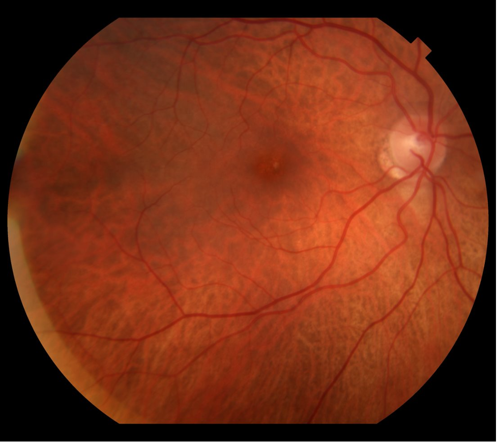 Vitamin A Deficiency