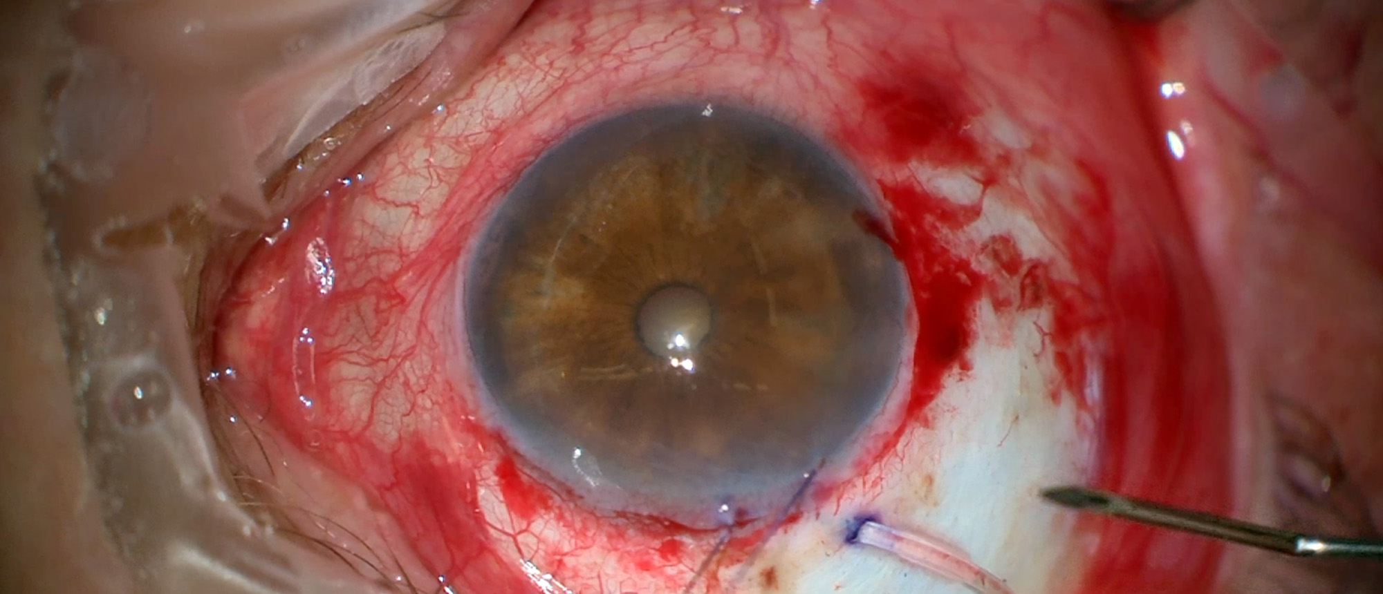 Glaucomatous Progression 