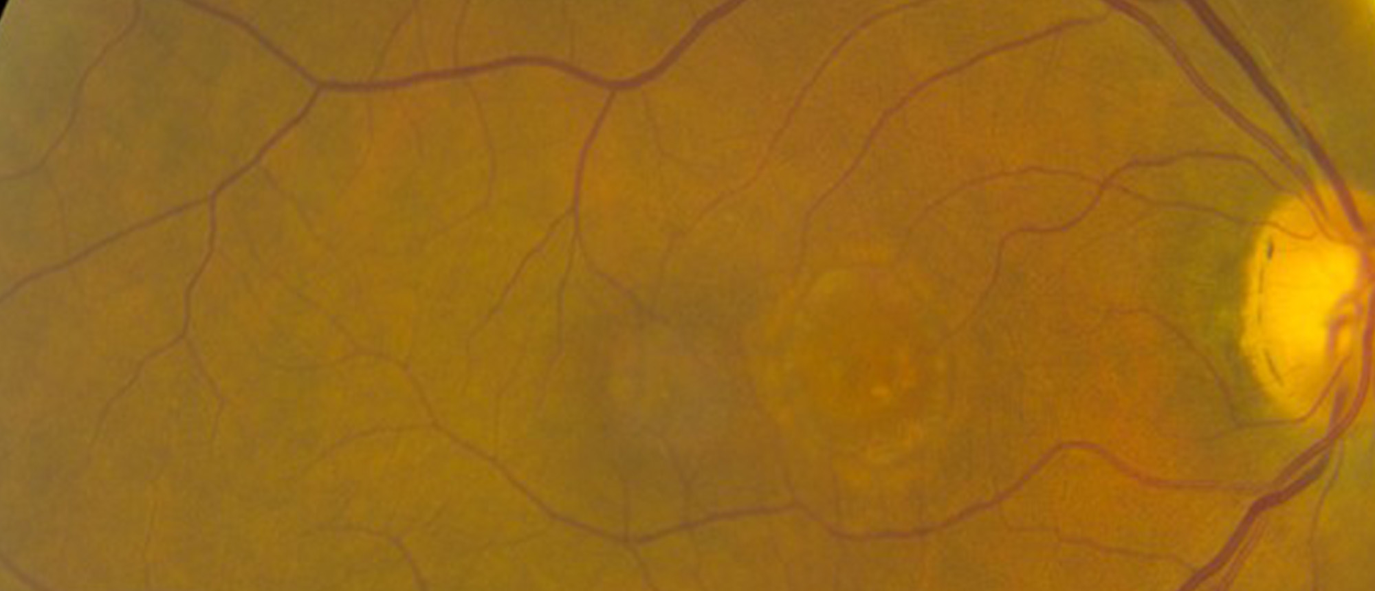 Adult Onset Foveomacular Vitelliform Dystrophy 