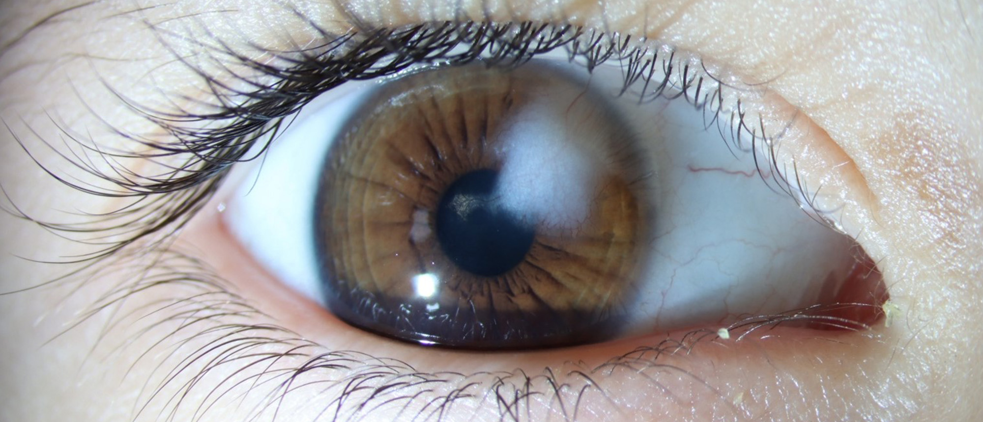 Congenital Corneal Keloid