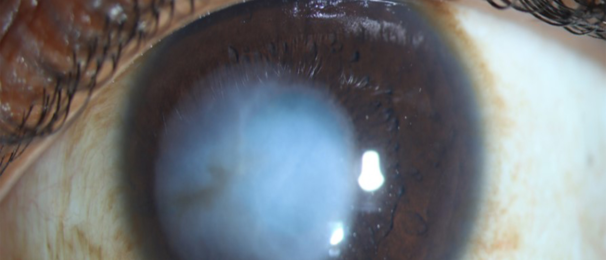 Vision Rehabilitation Post Corneal Scar 