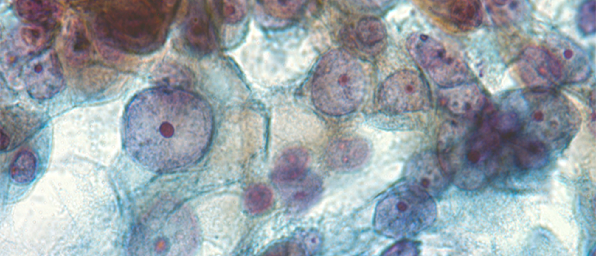 Carcinoma Consist with Metastasis and Lung Primary