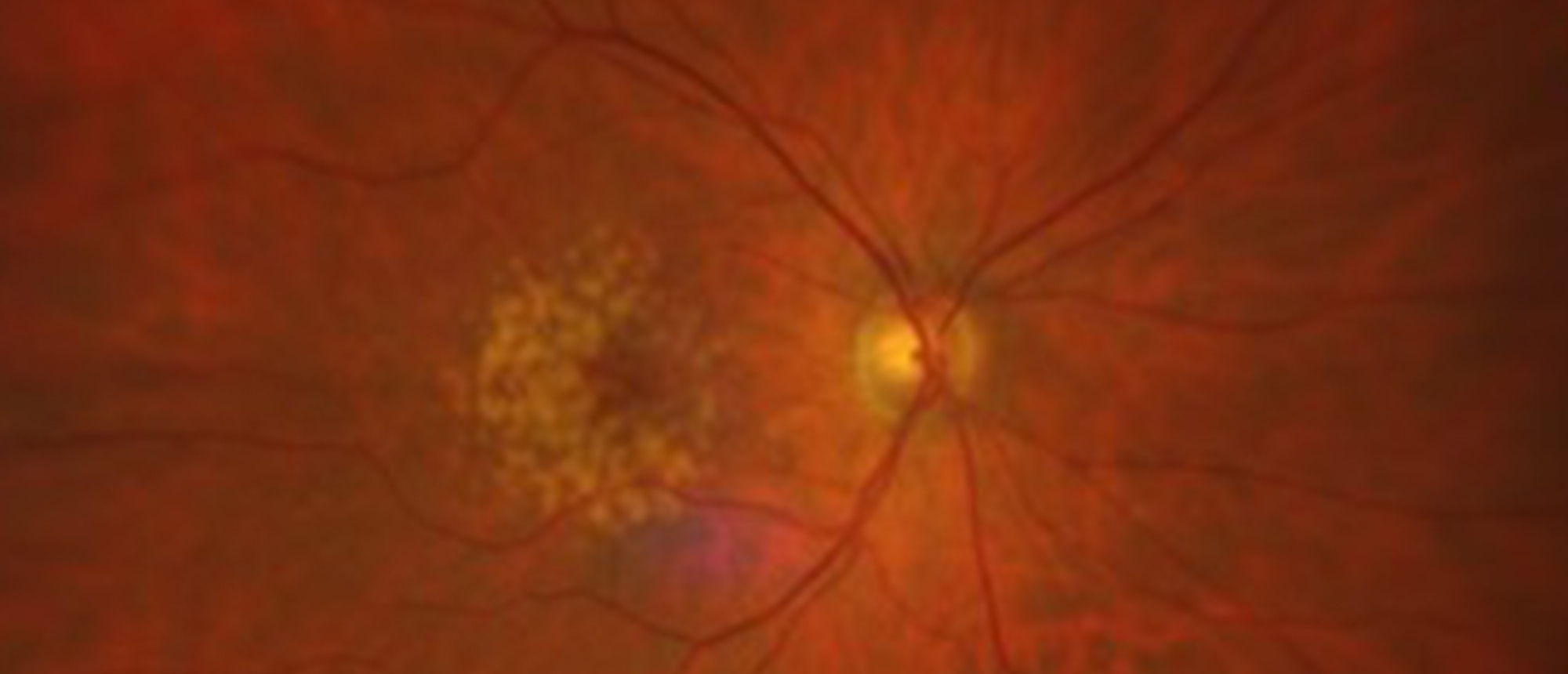 Type 1 MNV Evolves While Undergoing Anti-VEGF Therapy for Type 3 MNV